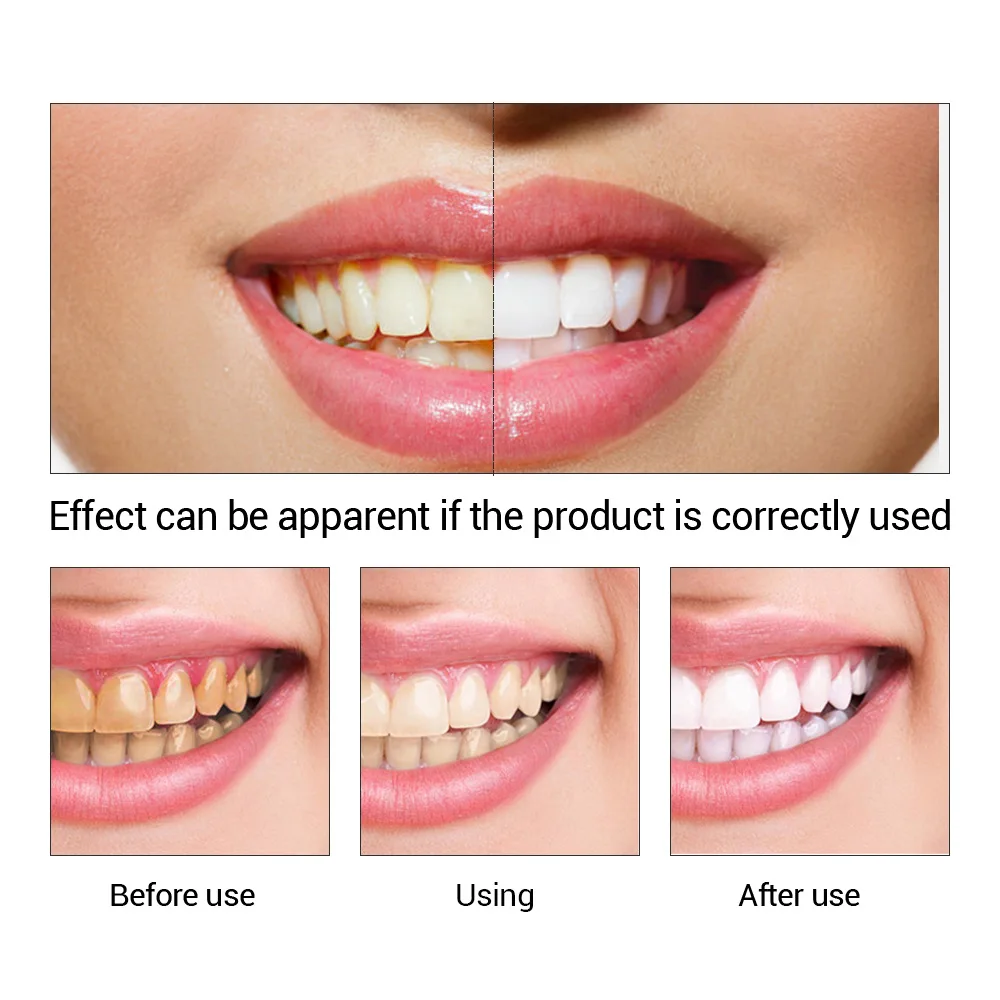 FTEENPLY Sbiancamento Dei Dent - Teeth Whitening Hismile recensione e prezzo