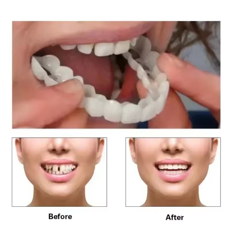 Faccette Dentali Sbiancanti, P - Teeth Whitening Veneers recensione e prezzo