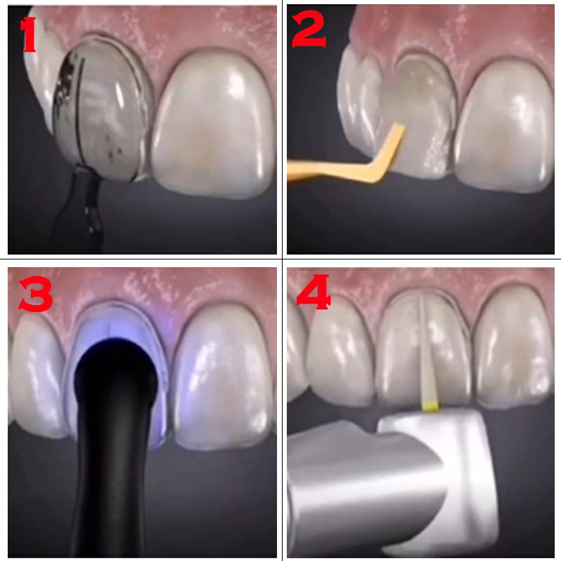 Stampo Dentale per Faccette in - Teeth Whitening Veneers recensione e prezzo