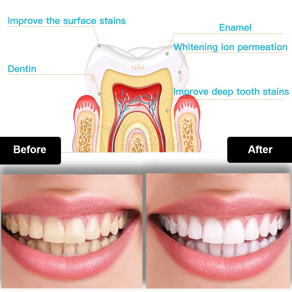 Kit per sbiancamento dei denti - Teeth Whitening Gels recensione e prezzo